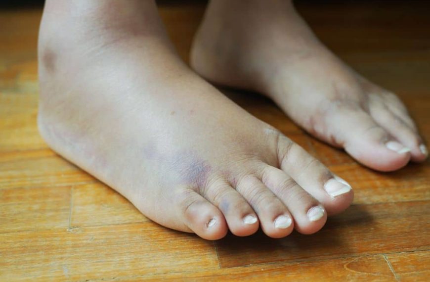 Gonfiore (edema) in gravidanza