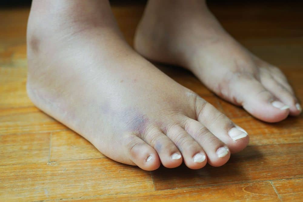 Gonfiore (edema) in gravidanza